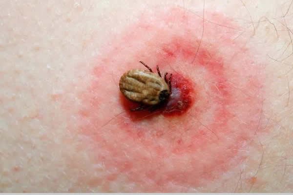 Muere niño por rickettsia en Juárez; alertan por garrapatas