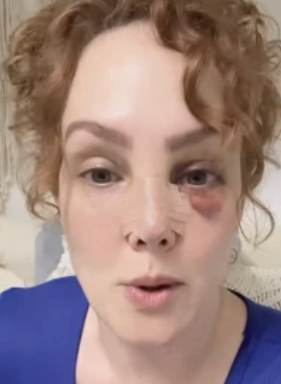 Fran Meric aclara cómo se le desfiguró el rostro